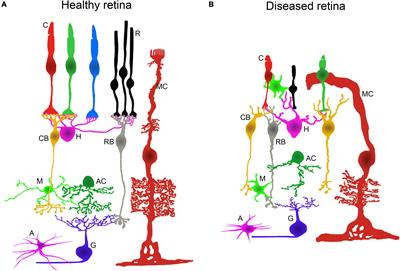 Cellular and molecular alterations in neurons and glial cells in inherited retinal degeneration